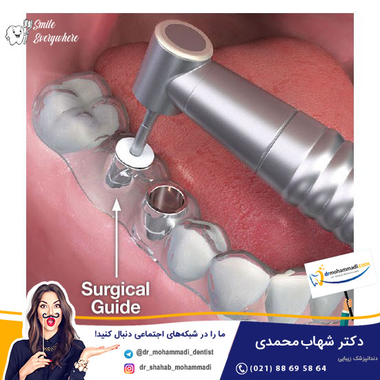 مزایا و معایب ایمپلنت بدون جراحی یا ایمپلنت فوری - کلینیک دندانپزشکی دکتر شهاب محمدی